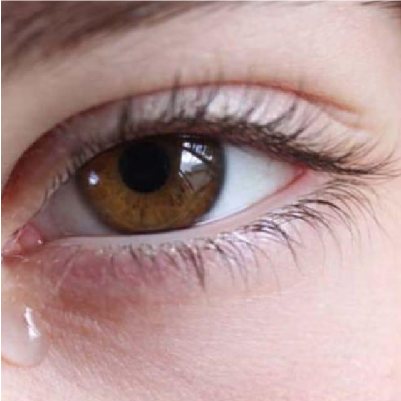 epifora - urotorrino salud