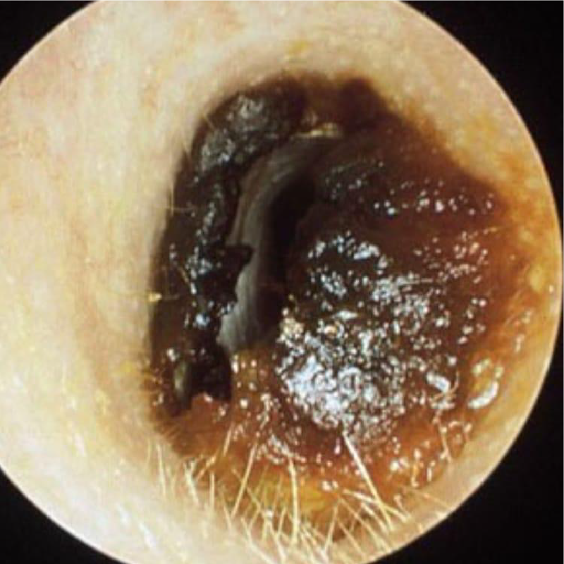 cerumen - urotorrino salud