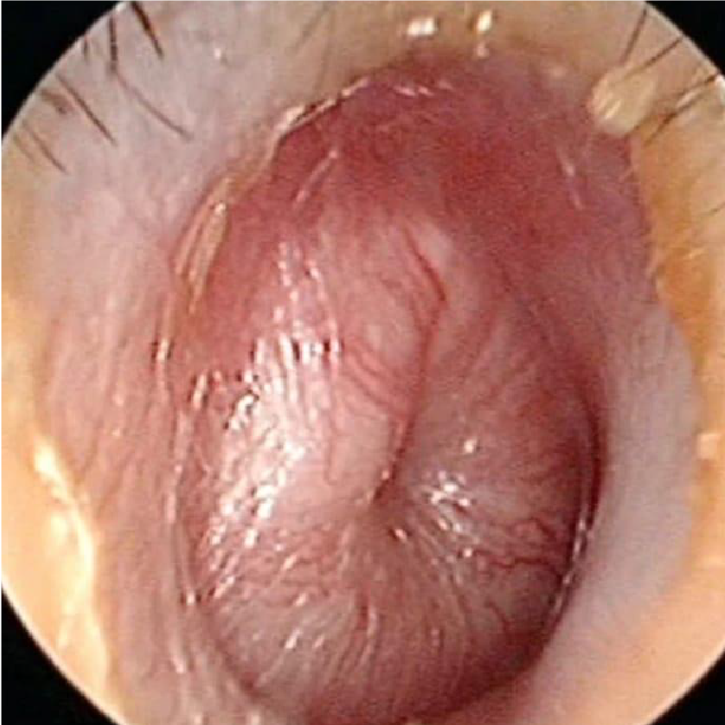 otitis media - urotorrino salud
