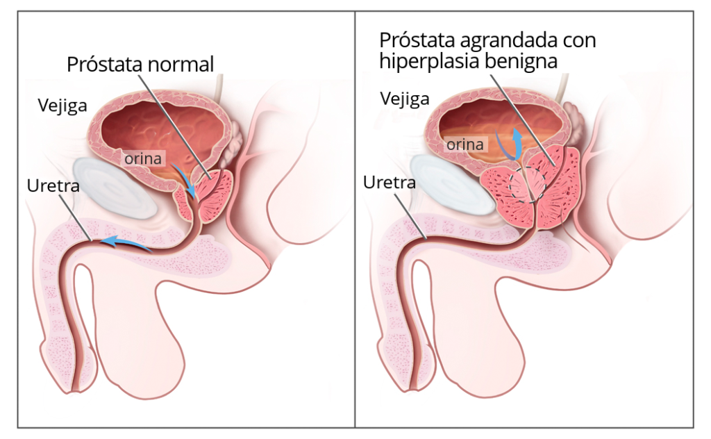 hiperplasia prostatica - urotorrino salud - urologo talca, chile